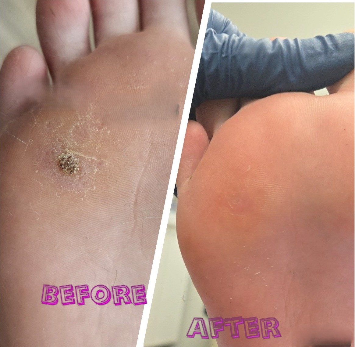 Plantar Wart Removal at South London Mole Clinic