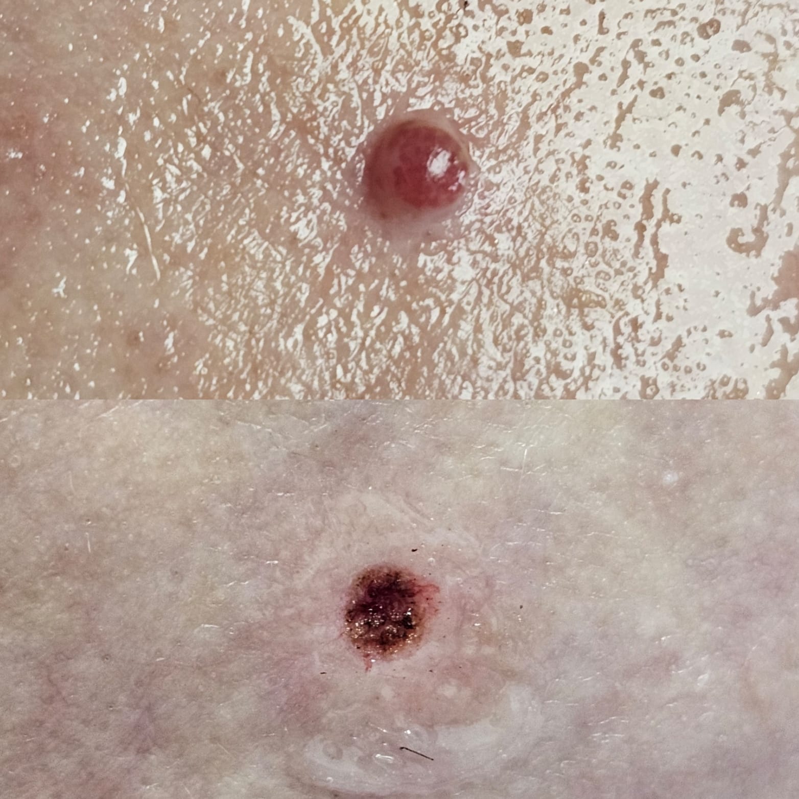 Cherry Angioma